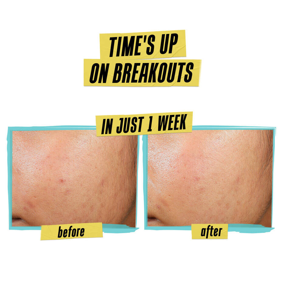 Expertly Clear Blemish-Targeting & Preventing Lotion