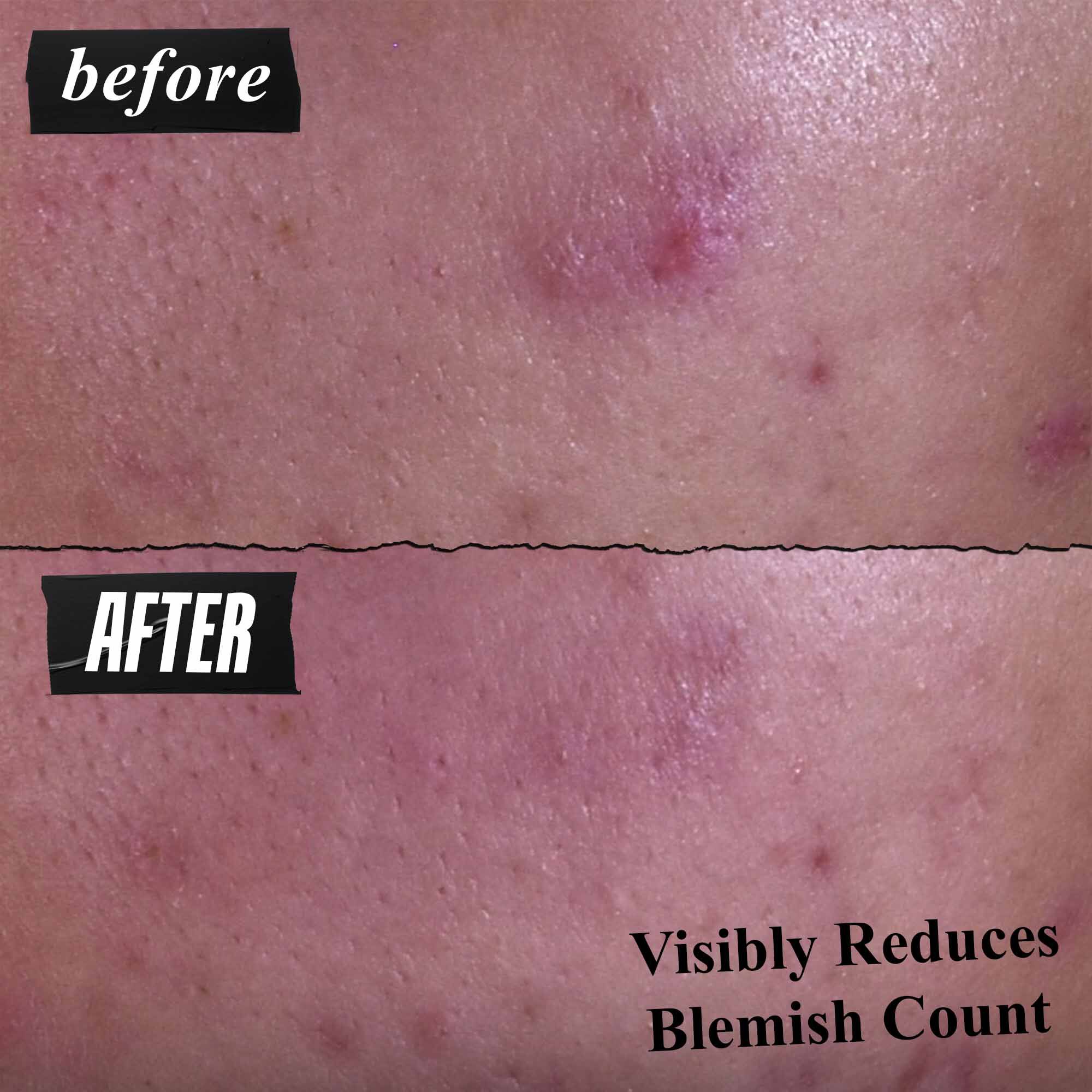 Results of using Gently Effective Blemish-Treating Cleansing Paste​