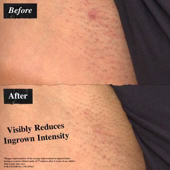 Ingrown Hair & Tone-Correcting Intimate Drops